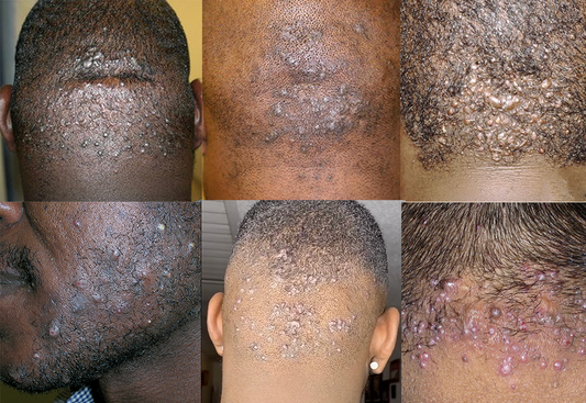 a collection of images of Acne Keloidalis Nuchae,razor bumps, ingrown hairs