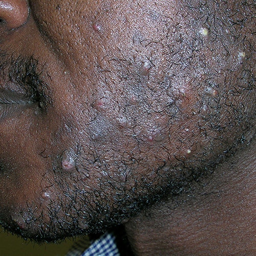 razor bumps on black mans face